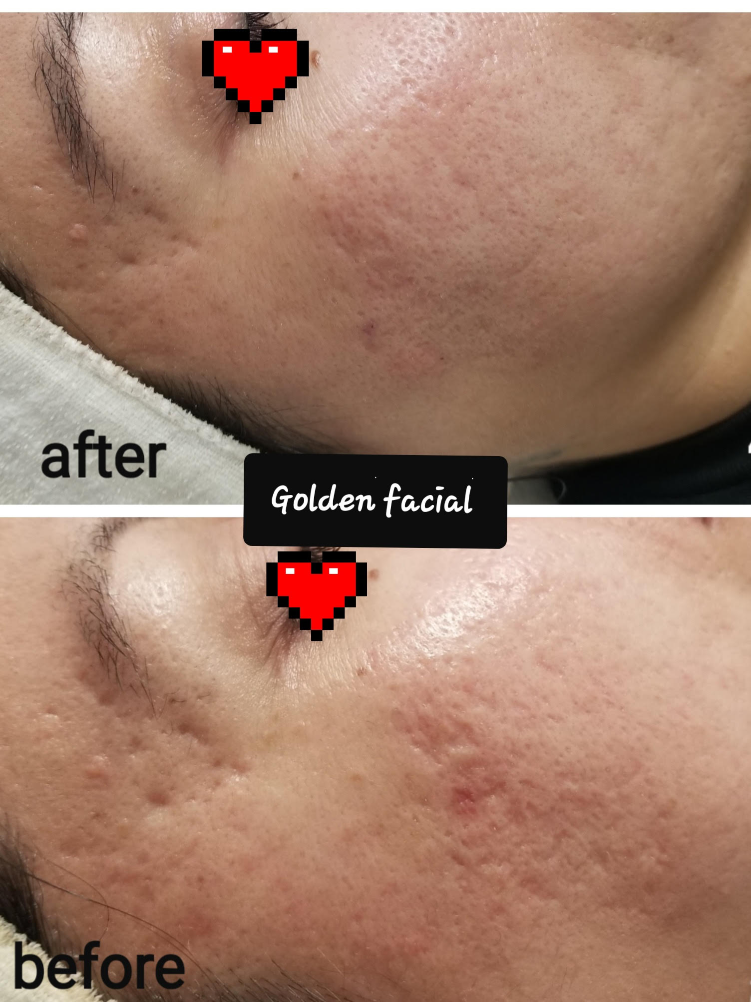 MICRONEEDLING